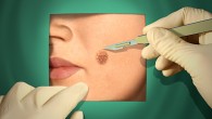 When would you choose surgery over Curaderm BEC5? Curaderm BEC5 is a highly effective treatment for non-melanoma skin cancers and has numerous inherent advantages over surgery such as: Lower cost Ability to be self-administered Less damage to surrounding healthy...