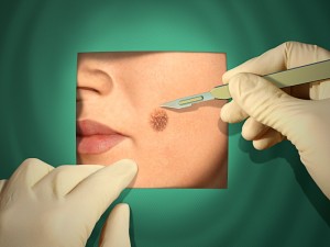 Melanona Surgery Melanona Surgery 300x225 When would you choose surgery over Curaderm BEC5?