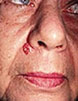 Basal Cell Carcinoma near Nose Basalcell4 Common Skin Cancer Locations