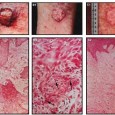 INTRODUCTION Squamous Cell Carcinoma (SCC) is a common cancer that formsÂ from malignant proliferation of the keratinocytes of the epidermis. Definitive treatment and early diagnosis will provide the best opportunity to […]