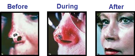 Basal Cell Cancer Pictures undergoing treatment with Curaderm Iris Before During After