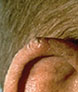 Squamous Cell Carcinoma on Ear