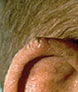 Squamous Cell Carcinoma on Ear scc011 Common Skin Cancer Locations
