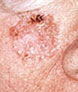 Squamous Cell Carcinoma on Cheek