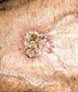 Squamous Cell Carcinoma on Arm