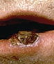 Squamous Cell Carcinoma on Lip