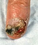 Squamous Cell Carcinoma on Finger
