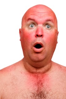 Man with Sunburn Man with Sunburn Take care of yourself in the sun