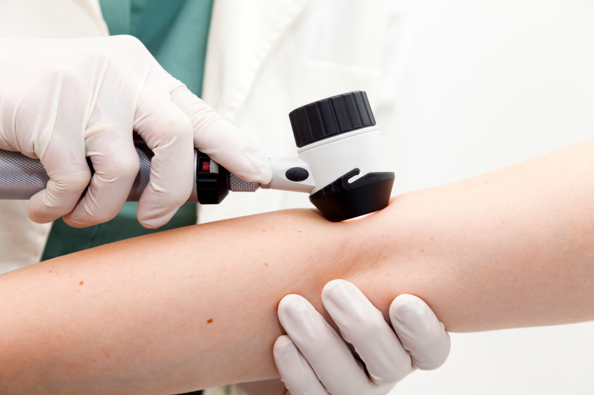Melanoma Exam iStock 000016194784Small Can I use Curaderm BEC5 without seeing a doctor first?