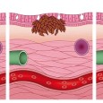 Melanoma Identification Melanoma is a very serious and dangerous form of skin cancer. Melanoma can sometimes be curable if you identify and get it treated ASAP. If you think that you mole...