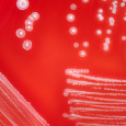 If you experience discharge during treatment with Curaderm it is most likely dead cancer cells being ‘mopped up’ by phagocytes (white blood cells) and this is a normal experience during treatment...