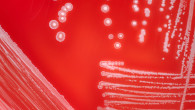 Is it Normal to Experience Discharge or Pus During Treatment with Curaderm? If you experience discharge during treatment with Curaderm it is most likely dead cancer cells being ‘mopped up’ by phagocytes (white blood cells) and this is a normal experience during treatment...