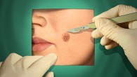 Curaderm BEC5 is a highly effective treatment for non-melanoma skin cancers and has numerous inherent advantages over surgeryÂ such as: Lower cost Ability to be self-administered Less damage to surrounding healthy […]